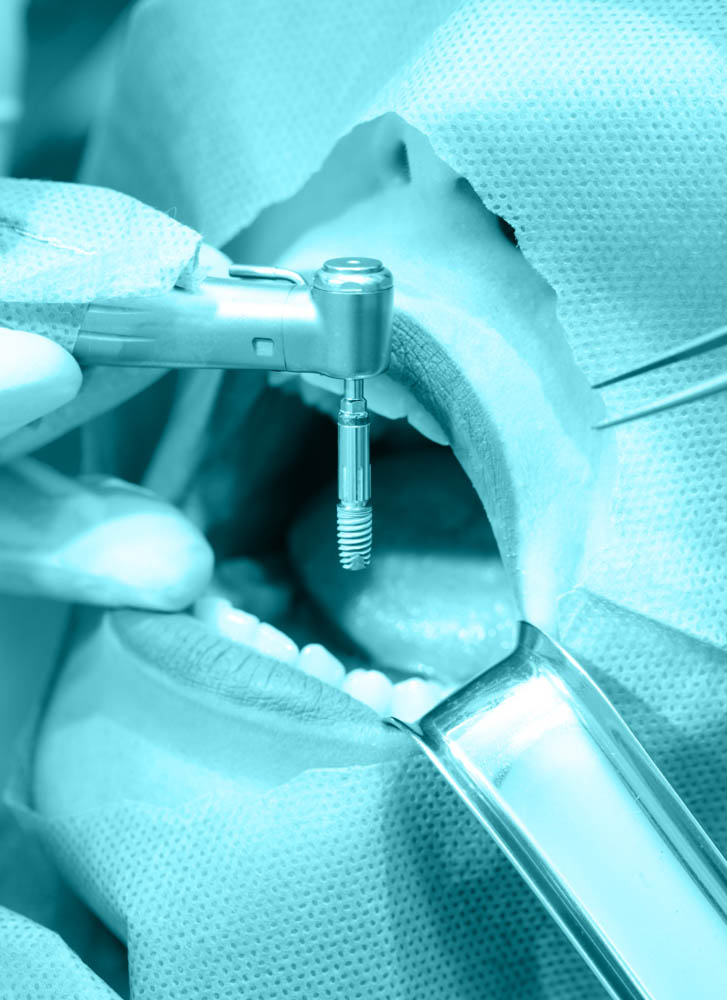 impianti dentali
